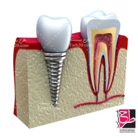 دانلود تصویر با کیفیت دندان سالم و دندان ایمپلنت